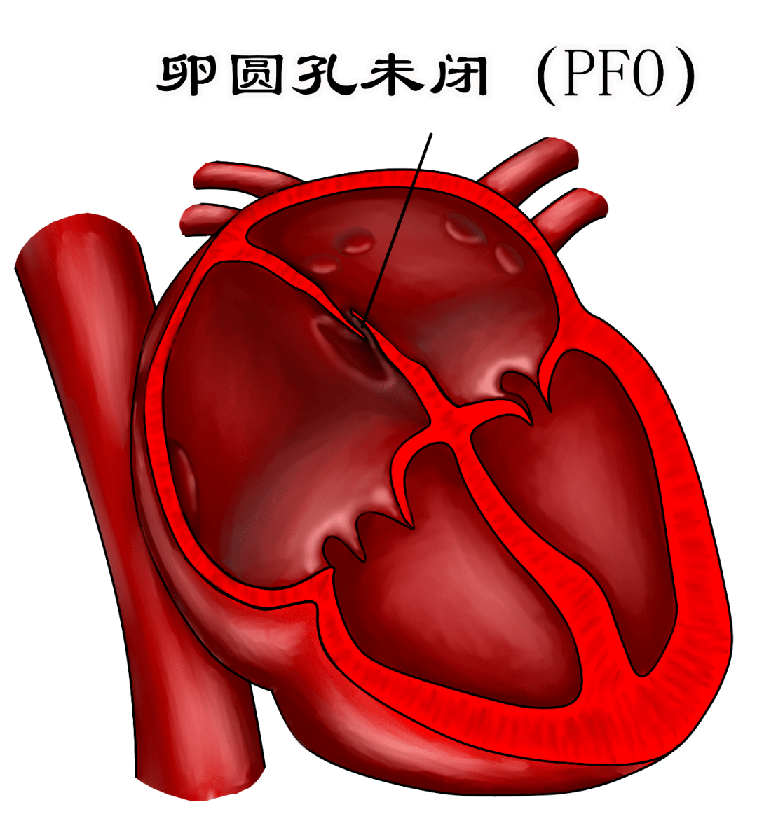痛起来"生不如死"的偏头痛,很多人终于能找到原因了!