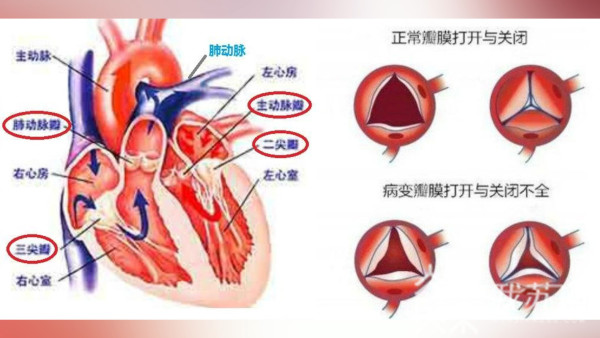 以往,心脏瓣膜病都要做开胸手术.