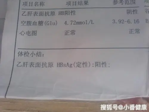 乙肝dna,即乙肝病毒的脫氧核糖核酸,陽性就不可掉以輕心