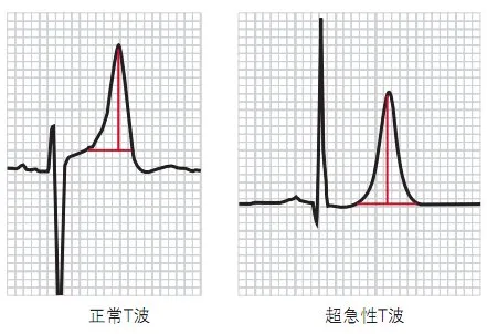 10分鐘掌握標準心電圖的基礎知識