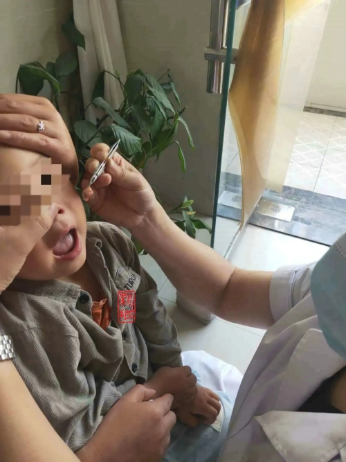 洋县三岁幼童将花生米吸进鼻孔