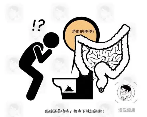 結腸癌早期靜悄悄?醫生告誡:身體若有4個