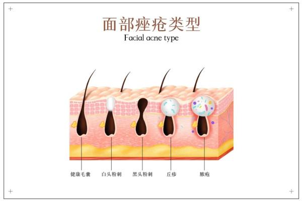 因為它花季少女滿臉痘 專家:搞清病因是關鍵